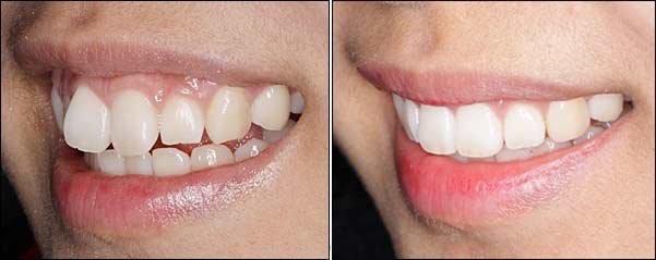 开封皓齿牙美白手术如何避免副作用_开封皓齿牙美白术的副作用，有哪些不良反应